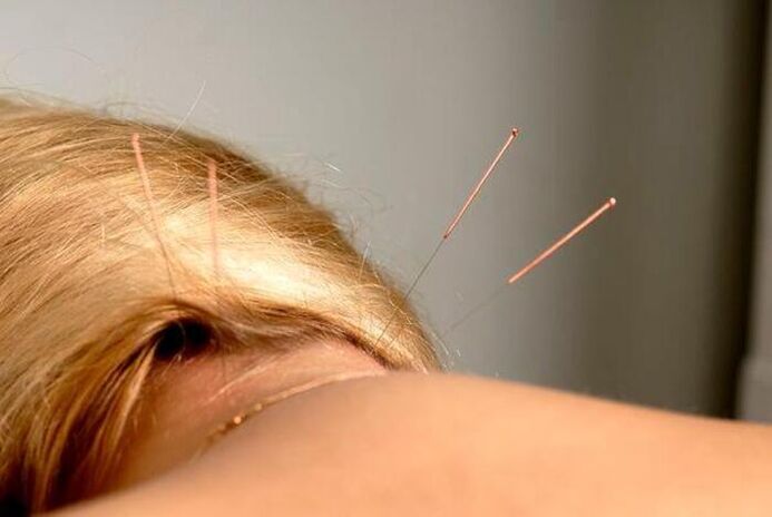 acupuncture for the treatment of osteochondrosis
