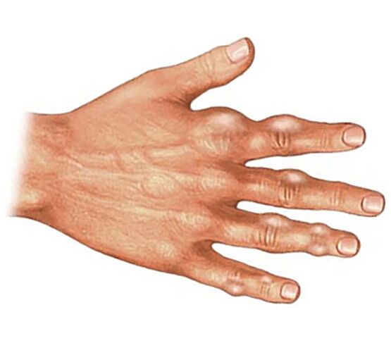 Deposition of uric acid crystals in the soft tissues of the fingers in the case of gouty arthritis