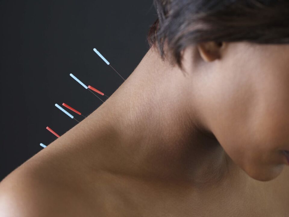 Acupuncture for cervical osteochondrosis eliminates inflammatory processes