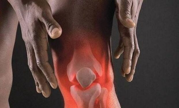 Arthritis is accompanied by an inflammatory process in the knee joint